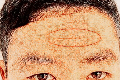 【额头皱纹<strong>面相</strong>】额头有疤<strong>面相</strong>
