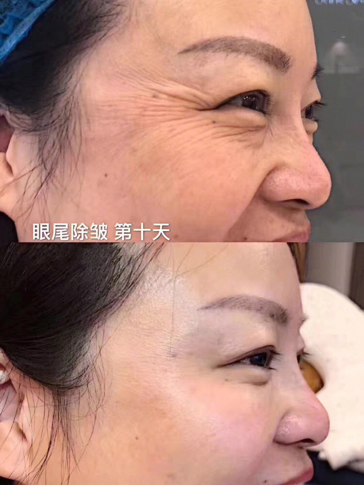 额头竖纹<strong>面相</strong>图解 有竖纹的额头<strong>面相</strong>图