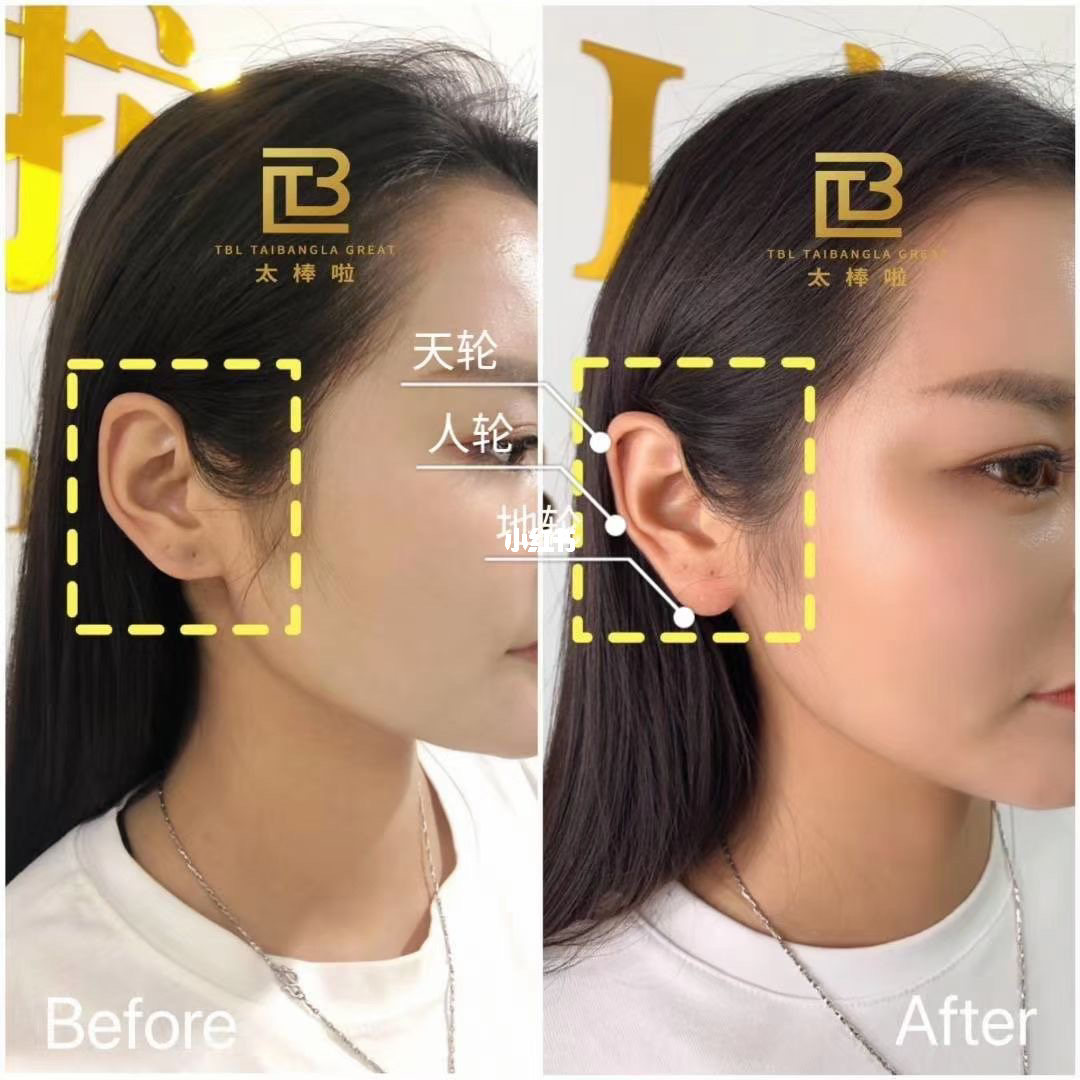耳朵上有痣的<strong>痣相</strong>图解