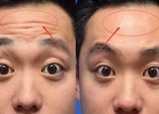 额头纹的解释 各种额头纹的特点