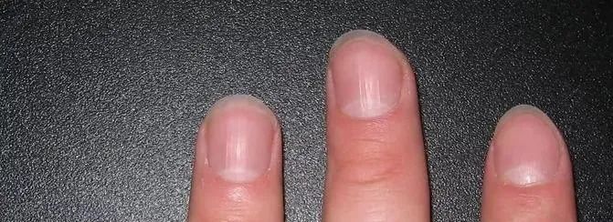 指甲在医生眼里，它还能成为人体健康的缩影，手指甲长这样，多半是身体在“求救”！