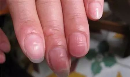 指甲在医生眼里，它还能成为人体健康的缩影，手指甲长这样，多半是身体在“求救”！